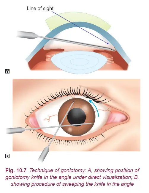 Types of Glaucoma Surgery for Glaucoma Treatment. 4 goniotomy, types of glaucoma surgery
