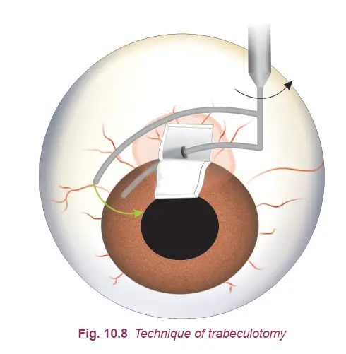 Types of Glaucoma Surgery for Glaucoma Treatment. 5 image 24