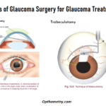 types of glaucoma surgery