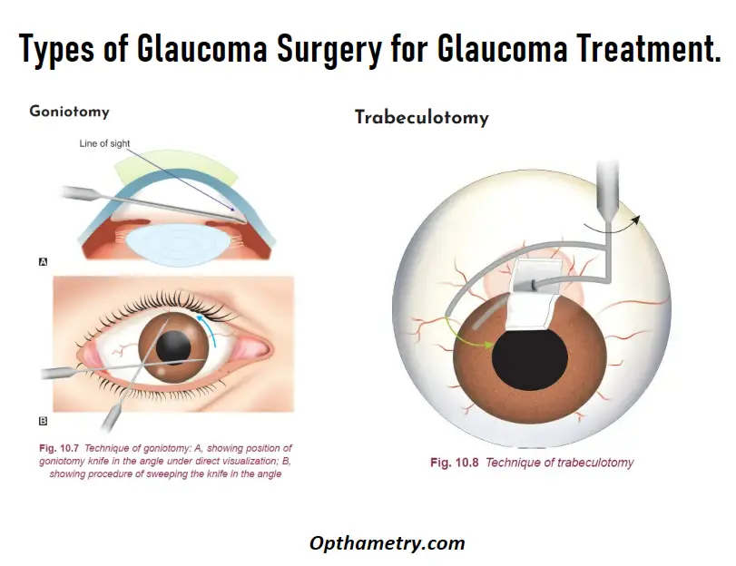 types of glaucoma surgery