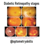 Diabetic Retinopathy stages 9 diabetic retinopathy stages