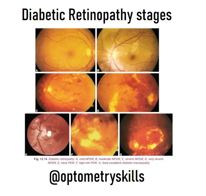 diabetic retinopathy stages