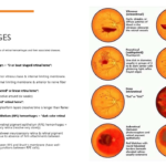 Types of Retinal Hemorrhages and its treatment. 10 Types of Retinal Hemorrhages and its treatment
