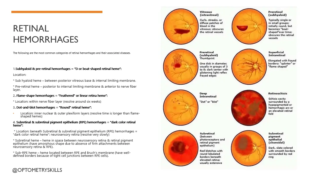Types of Retinal Hemorrhages and its treatment