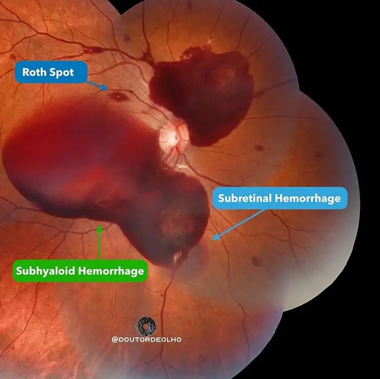 Types of Retinal Hemorrhages and its treatment