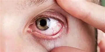 Dry eye syndrome