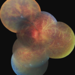 Frosted Branch Angiitis