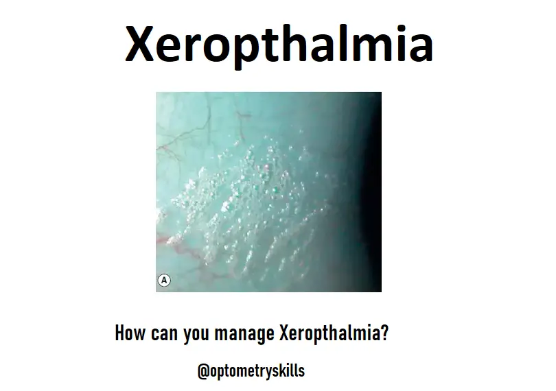 xeropthalmia