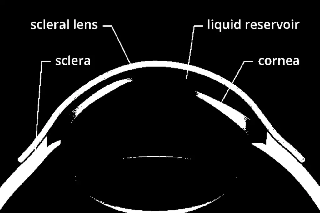 Scleral Lenses Insurance Coverage 2 image 26