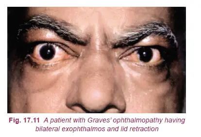 Detecting Thyroid Eye Disease and treatment options of Graves Ophthalmopathy 2 Detecting Thyroid Eye Disease