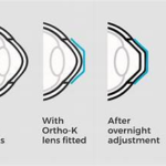 Ortho K vision lens