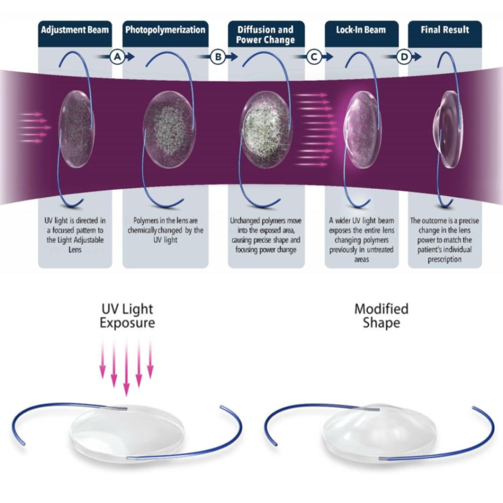 What are the Light Adjustable Lens that is used after Cataract surgery? 2 image 39