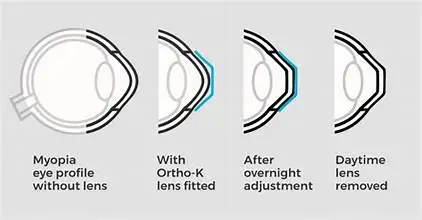 Ortho K vision lens