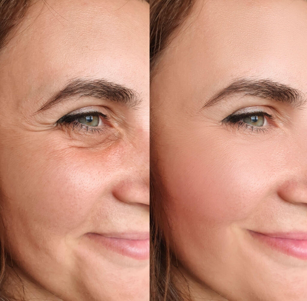Pelleve treatment for eye, wrinkle reduction 3 Pelleve treatment for eye, wrinkle reduction