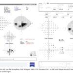Mastering Automated Perimetry: Essential Tips and Tricks. 12 Mastering Automated Perimetry: Essential Tips and Tricks for Optometrists