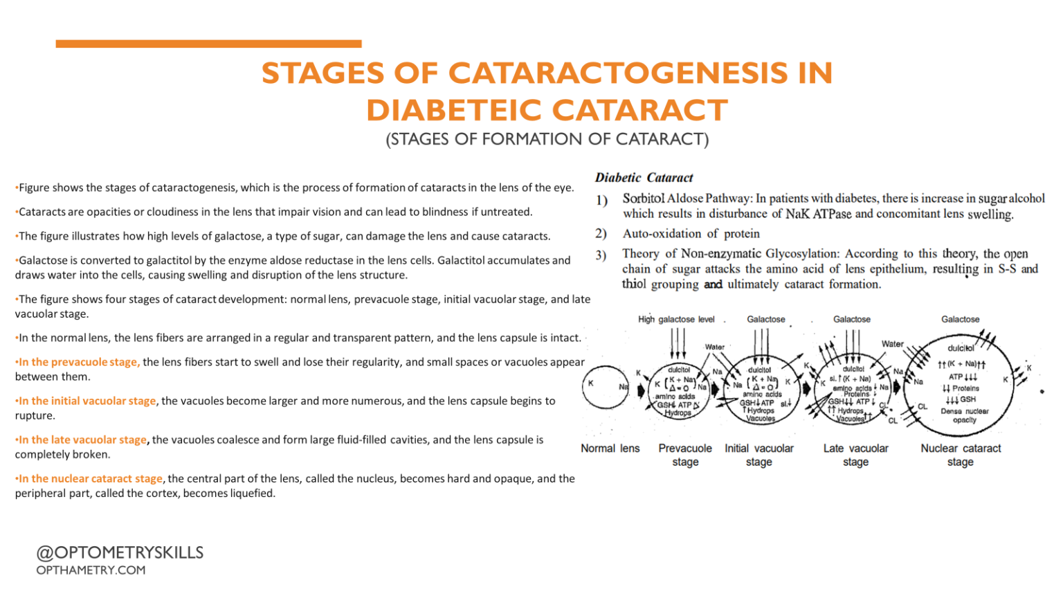 Diabetic Cataract, Infograph. - An Eye Care Blog