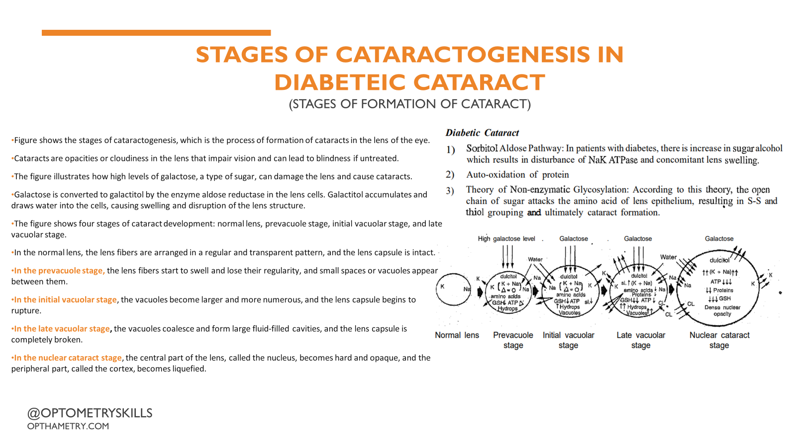 Diabetic Cataract Infograph