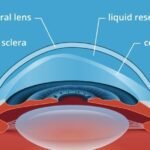 Scleral Contact Lenses.