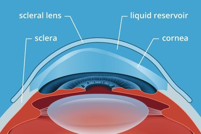 Scleral Contact Lenses.