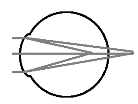 What is Mixed Astigmatism?