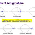 What is Mixed Astigmatism?