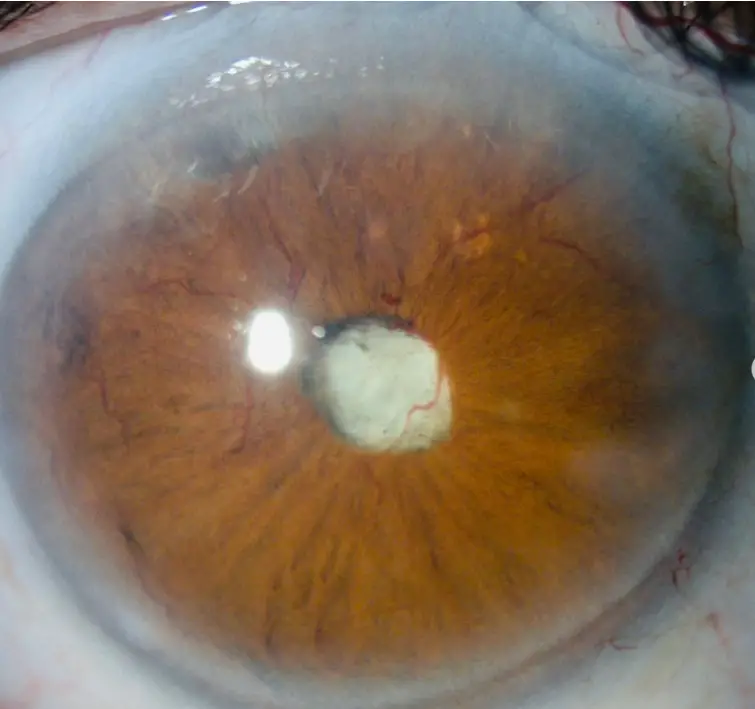 eye case Quiz Rubeosis iridis.