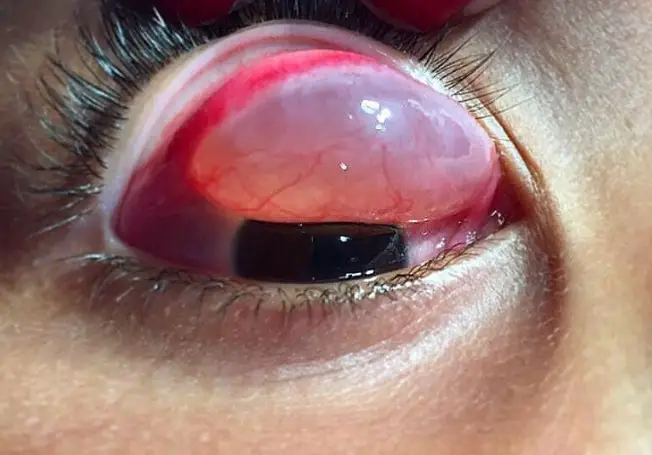 optometry case Giant conjunctival inclusion cyst