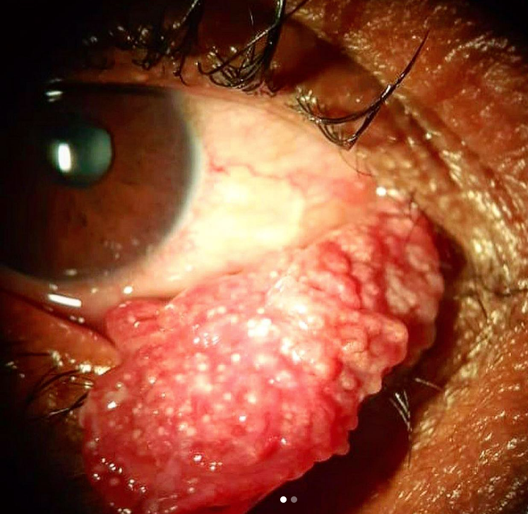 Pedunculated conjunctival papilloma