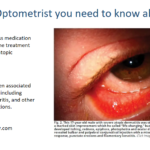 Why as an Optometrist you need to know about Dupixent? 11 dupixent before and after photos
