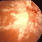 CMV Retinitis