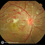 Diagnosing Hypertensive Retinopathy 12 Diagnosing Hypertensive Retinopathy