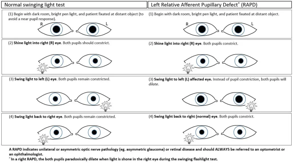 What is PERRLA Eye Testing? 4 image 21