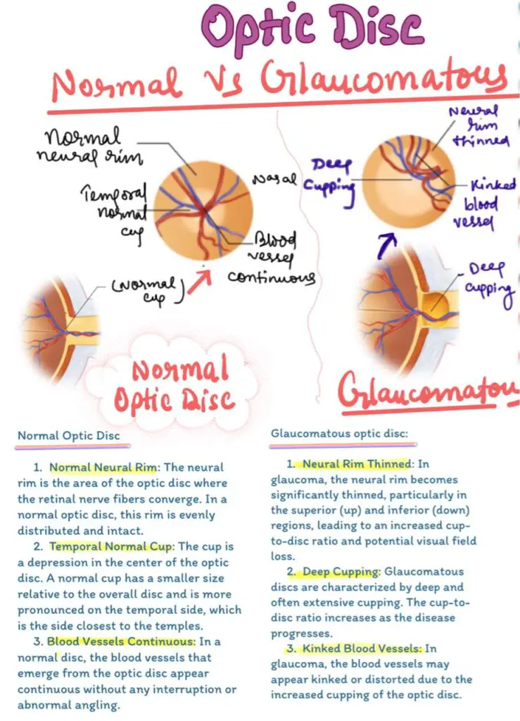 Difference in Optic Disc of Normal and glaucomatous Disc