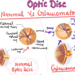 Difference in Optic Disc of Normal and glaucomatous Disc 10 image 1
