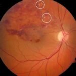 Diagnosis challenge- Is this Cotton wool spot or exudate? 10 4499c73d 6333 4bfc 8385 6a593409983d 12233 000001ebe19b236f file