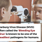 Bleeding Eye Virus Sparks Travel Warning and Worldwide Concern. 10 Bleeding Eye Virus