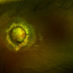 Optic Disc Abnormalities: Diagnosis, Types and Impact on Vision 9 image