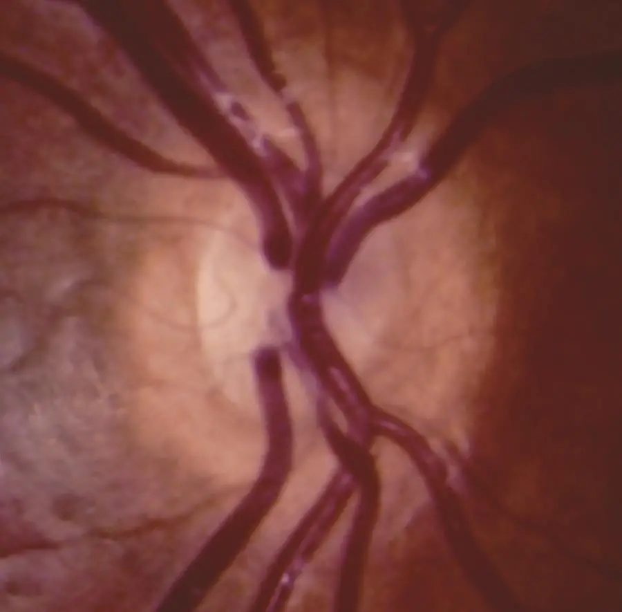 Optic Disc Abnormalities ONH