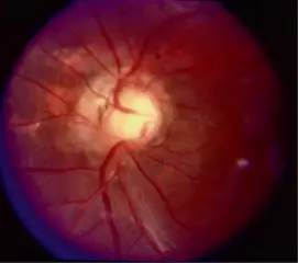 Optic Disc Abnormalities optic disc coloboma