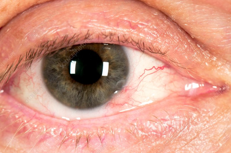 Differential Diagnoses of Conjunctival Masses - An Eye Care Blog