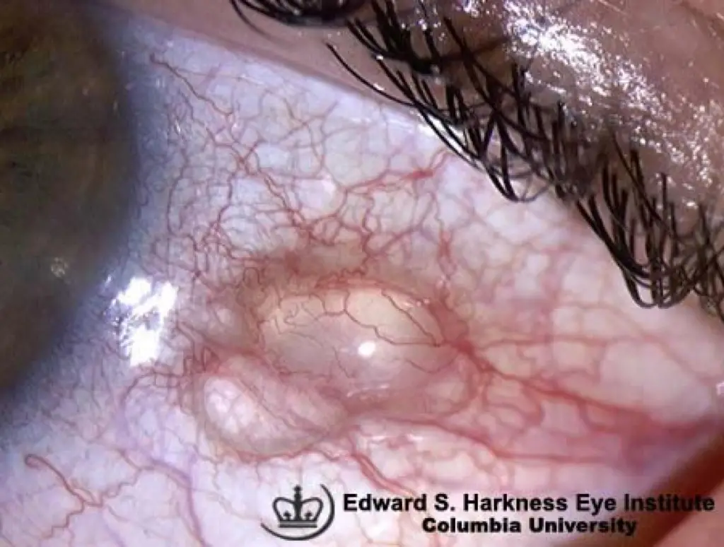 Differential Diagnoses of Conjunctival Masses