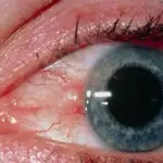 Differential Diagnoses of Conjunctival Masses