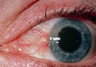 Differential Diagnoses of Conjunctival Masses