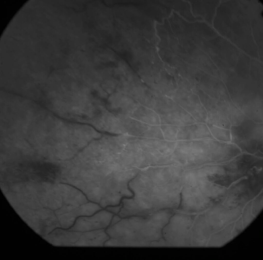Eales Disease: A Rare Retinal Disorder with Sight-Threatening Consequences 3 ae0cbe3a dea7 4c17 82c0 7978b210ccb8 66645 000006c9bd111ce0 file