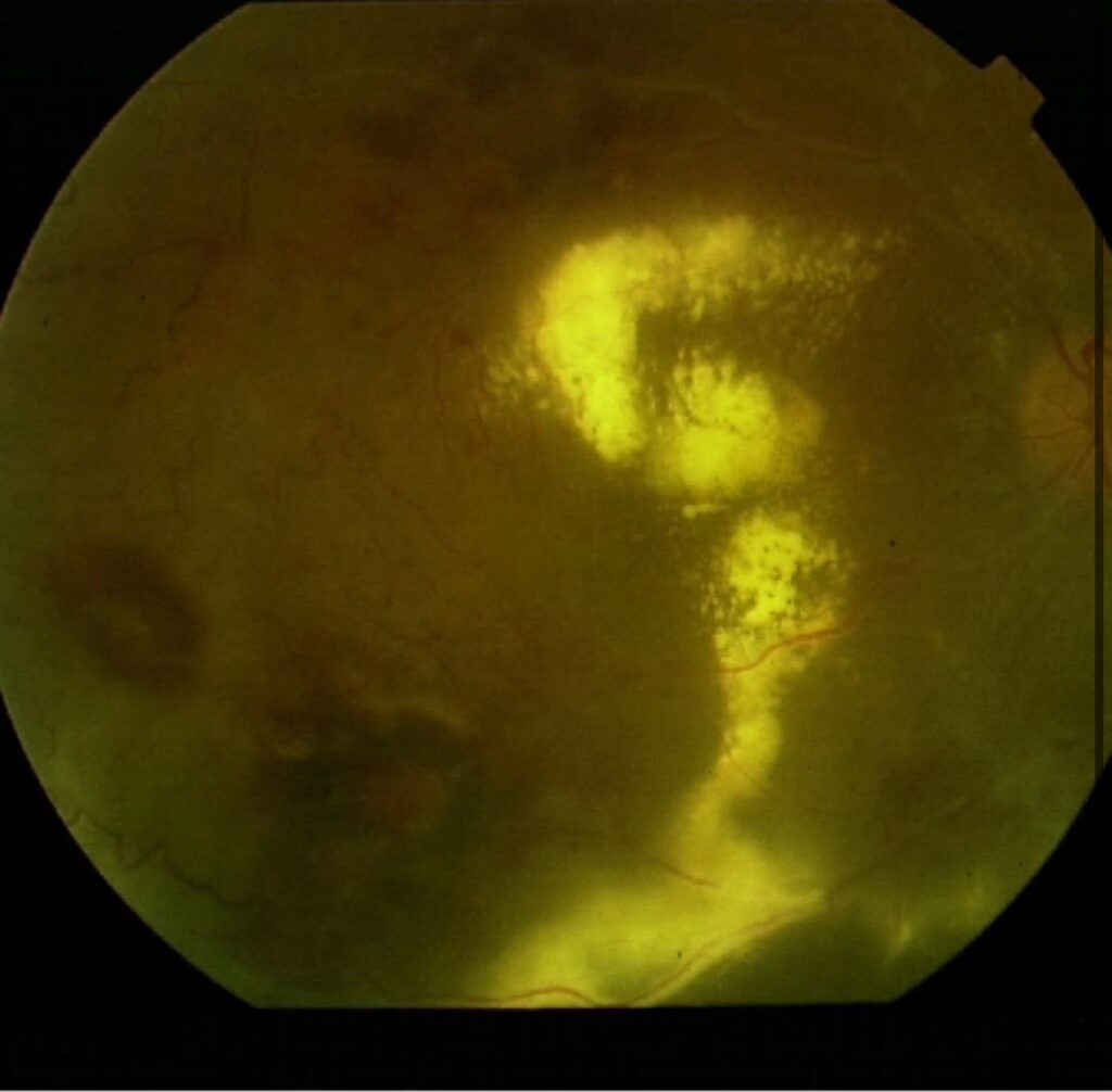Eales Disease: A Rare Retinal Disorder with Sight-Threatening Consequences 2 c107b560 76b7 4edc 9f17 96d0af8c6033 66645 000006c9536859f8 file