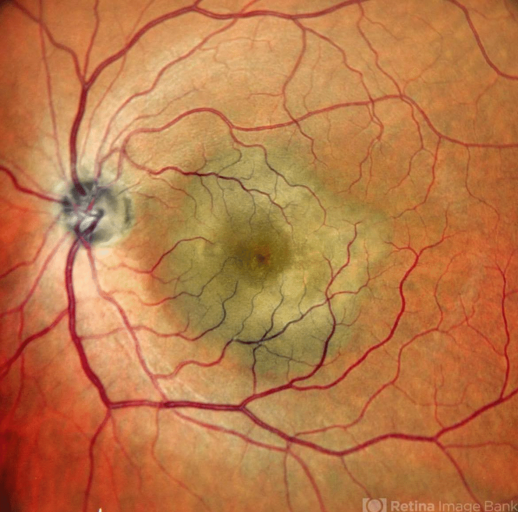 Understanding Posterior Scleritis 2 image 3
