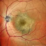posterior scleritis