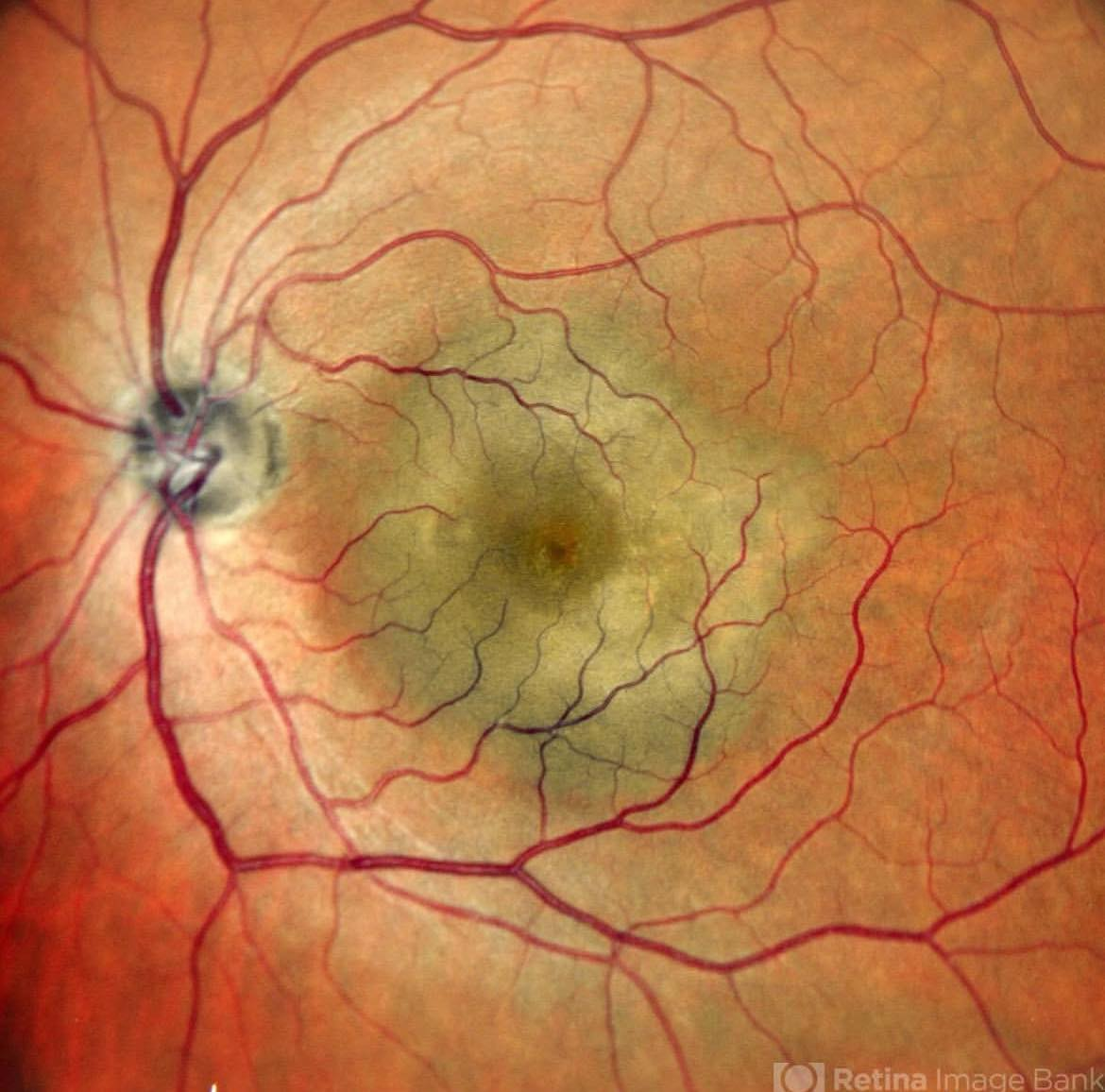 posterior scleritis