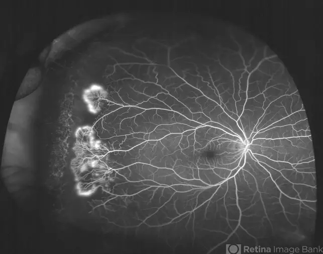 Sickle Cell Retinopathy case 3 Sickle Cell Retinopathy case