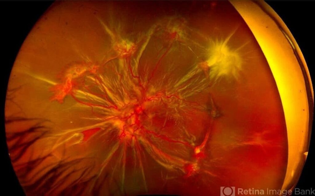 Sickle Cell Retinopathy case 2 img 5651 2 1